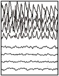 Apreensão parcial EEG