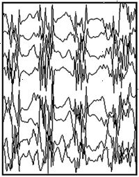Apreensão generalizada EEG