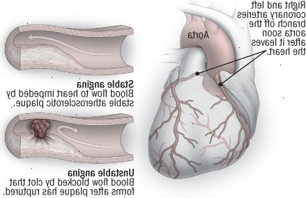 A angina estável e instável