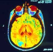 Uma ressonância magnética do cérebro pode mostrar se o câncer se espalhou (metástase) lá.