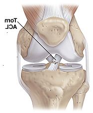 Vista frontal do joelho mostra os músculos, ossos, articulações e ligamentos, com rasgo parcial do ligamento cruzado anterior.