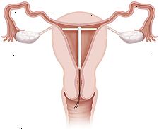 Secção transversal do útero e vagina DIU exibição no lugar dentro do útero.