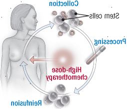 Procedimento de transplante de células-tronco