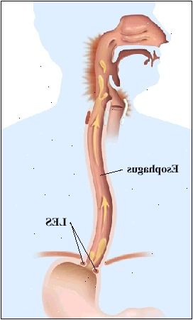 Esboço de uma figura humana, mostrando a anatomia do sistema digestivo superior da boca ao estômago. Esôfago passa por diafragma para se conectar ao estômago. Fraco LES é aberto e setas mostram o movimento do conteúdo gástrico para dentro do esôfago e parte de trás da garganta. Parte de trás da garganta está inflamada.