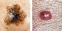 Foto comparando moles normais e melanoma mostrando assimetria