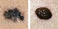 Foto comparando moles normais e melanoma mostrando irregularidade fronteira