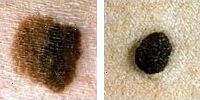 Foto comparando normal e moles melanoma mostrando cor