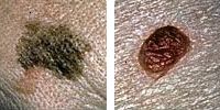 Foto comparando moles normais e melanoma mostrando diâmetro