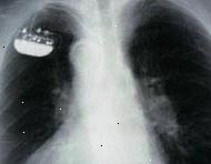 Raios-X de uma única câmara implantado pacemaker