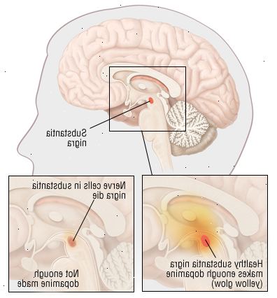 Parkinson