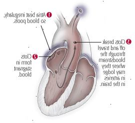 A fibrilação atrial 2