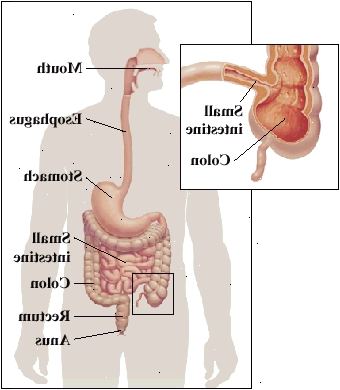 Qualquer parte do trato digestivo, desde a boca até o ânus, podem ser afetados. Encontra-se frequentemente que o intestino eo cólon pequeno se encontram.