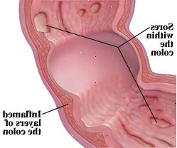 A doença de Crohn pode afectar todas as camadas do tracto digestivo.