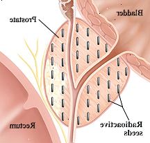 Seção transversal do close up da bexiga, próstata e reto. Sementes radioactivas são implantados ao longo da próstata.
