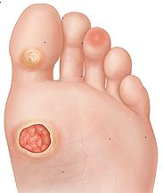 Sola do pé mostrando úlcera na bola do pé, calo na base do dedão do pé, e ponto quente na almofada do terceiro dedo do pé.