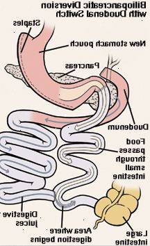 Vista frontal do estômago e duodeno. Estômago foi cortado e grampeado. Corte final do intestino delgado foi educado para se conectar ao estômago. Duodeno foi cortado e recolocado para intestino delgado. Seta mostra comida passando de estômago para o intestino delgado encurtado. Uma outra seta mostra caminho dos sucos digestivos do estômago através do duodeno e no intestino delgado. A digestão começa na intestino delgado.