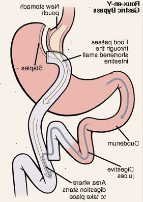 Vista frontal do estômago e duodeno. Estômago foi cortado e grampeado para formar bolsa. Corte final do intestino delgado foi educado para se conectar a bolsa do estômago. Duodeno foi cortado e recolocado para intestino delgado. Seta mostra comida passando de estômago para o intestino delgado encurtado. Uma outra seta mostra caminho dos sucos digestivos do estômago através do duodeno e no intestino delgado. A digestão começa na intestino delgado.