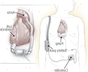 Dispositivo de Assistência Ventricular (DAV)