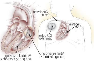 Desfibriladores cardíacos implantáveis