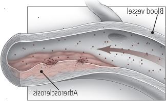 Dentro de uma artéria estreitada