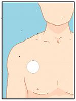 Aplique o patch para um local seco no peito, costas, ou no braço.