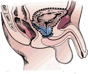 Limites cirúrgicos de cistectomia radical em um homem. A amostra inclui a bexiga, a próstata, e as vesículas seminais.
