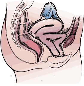 Limites cirúrgicos de cistectomia radical em uma mulher. A amostra inclui a bexiga e uretra inteiro, útero, ovários, trompas de falópio, e a parede anterior da vagina.