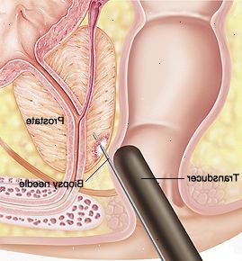 Seção transversal do close up de próstata e reto. Transdutor é inserido no recto e agulha é inserida na próstata.