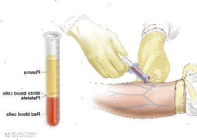 Hemograma completo (CBC). O sangue é recolhido através da inserção de uma agulha na veia e permitindo que o sangue flua para dentro de um tubo. A amostra de sangue é enviada para o laboratório e os glóbulos vermelhos, glóbulos brancos, plaquetas e são contadas. O CBC é usado para testar, diagnosticar e monitorizar diversas doenças.