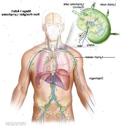 Estágio I adulto linfoma não-hodgkin; desenho mostra câncer linfático em um grupo de nós acima do diafragma. Um detalhe mostra um linfonodo com um vaso linfático, uma artéria e uma veia. Células de linfoma que contêm câncer são mostrados no linfonodo.
