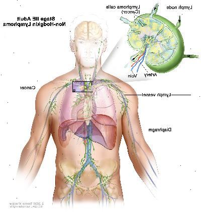Stage IIE adulto linfoma não-hodgkin; desenho mostra câncer linfático em um grupo de nós acima do diafragma e no pulmão esquerdo. Um detalhe mostra um linfonodo com um vaso linfático, uma artéria e uma veia. Células de linfoma que contêm câncer são mostrados no linfonodo.