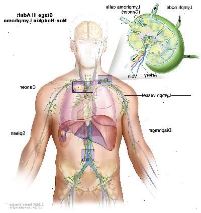 Estágio III adulto linfoma não-hodgkin. O cancro é encontrado em um ou mais grupos de linfonodos acima e abaixo do diafragma (um). No estágio IIIE, o câncer é encontrado em grupos de linfonodos acima e abaixo do diafragma e fora dos gânglios linfáticos no órgão ou área (b) nas proximidades. Na fase IIIS, cancro é encontrado em grupos de linfonodos acima e abaixo do diafragma (uma) e no baço (c). No estágio mais IIIS E, o câncer é encontrado em grupos de linfonodos acima e abaixo do diafragma, fora dos gânglios linfáticos em um órgão ou área (b) nas proximidades, e no baço (c).