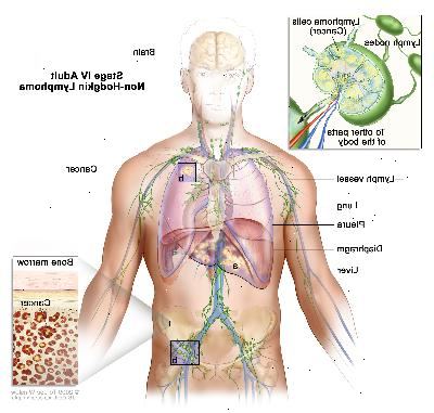 Fase IV adulto linfoma não-Hodgkin; desenho mostra cancro no fígado, o pulmão esquerdo, e, em um grupo de nó de linfa abaixo do diafragma. O cérebro ea pleura também são mostrados. Uma inserção mostra um close-up de câncer se espalhar através dos gânglios linfáticos e vasos linfáticos para outras partes do corpo. Células de linfoma que contêm câncer são mostrados dentro de um linfonodo. Outro detalhe mostra as células cancerígenas na medula óssea.