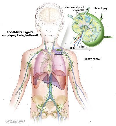 Estágio I infância linfoma não-hodgkin; desenho mostra o câncer em um grupo de linfonodos. Um detalhe mostra um linfonodo com um vaso linfático, uma artéria e uma veia. Células de linfoma que contêm câncer são mostrados no linfonodo.