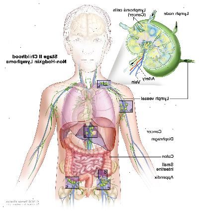 Estágio II infância linfoma não-hodgkin; desenho mostra câncer em grupos de linfonodos acima e abaixo do diafragma, no fígado e no apêndice. O cólon e do intestino delgado, também são mostrados. Um detalhe mostra um linfonodo com um vaso linfático, uma artéria e uma veia. Células de linfoma que contêm câncer são mostrados no linfonodo.