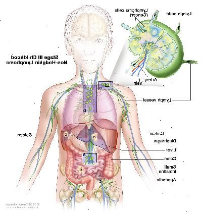 Fase III infância linfoma não-Hodgkin; desenho mostra cancro em grupos de linfonodos acima e abaixo do diafragma, no peito, e em todo o abdómen no fígado, baço, intestino delgado, e apêndice. O cólon também é mostrada. Um detalhe mostra um linfonodo com um vaso linfático, uma artéria e uma veia. Células de linfoma que contêm câncer são mostrados no linfonodo.