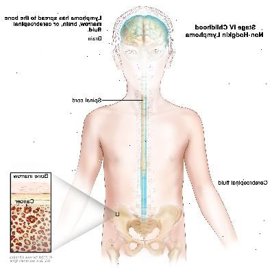 Estágio IV infância linfoma não-hodgkin; desenho mostra o cérebro, medula espinhal e no líquido cefalorraquidiano em torno do cérebro e da medula espinhal. Uma inserção mostra o cancro na medula óssea.