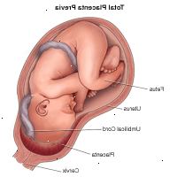 Ilustração demonstrando total de placenta prévia