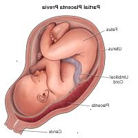 Ilustração demonstrando placenta prévia parcial
