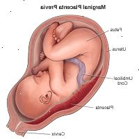 Ilustração da marginal placenta prévia