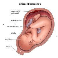 Demonstrando Ilustração escondido sangramento durante a gravidez