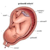Ilustração demonstrando sangramento visível durante a gravidez