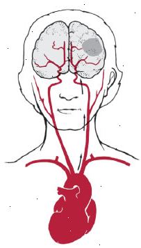 Coração, cérebro, triglicérides, acidente vascular cerebral