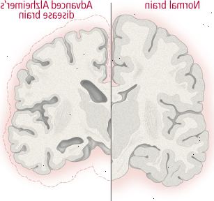 Mudanças no cérebro na doença de Alzheimer