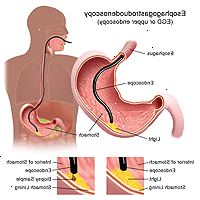 Ilustração de um procedimento de endoscopia digestiva alta