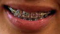 Imagem de uma boca que sorri com cintas