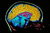 Uma imagem de um filme de ressonância magnética do cérebro