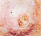 Carcinomas de células escamosas podem formar em locais expostos ao sol, ou em outros lugares.