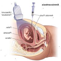 Ilustração demonstrando uma amniocentese