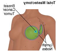 Ilustração de uma mastectomia total